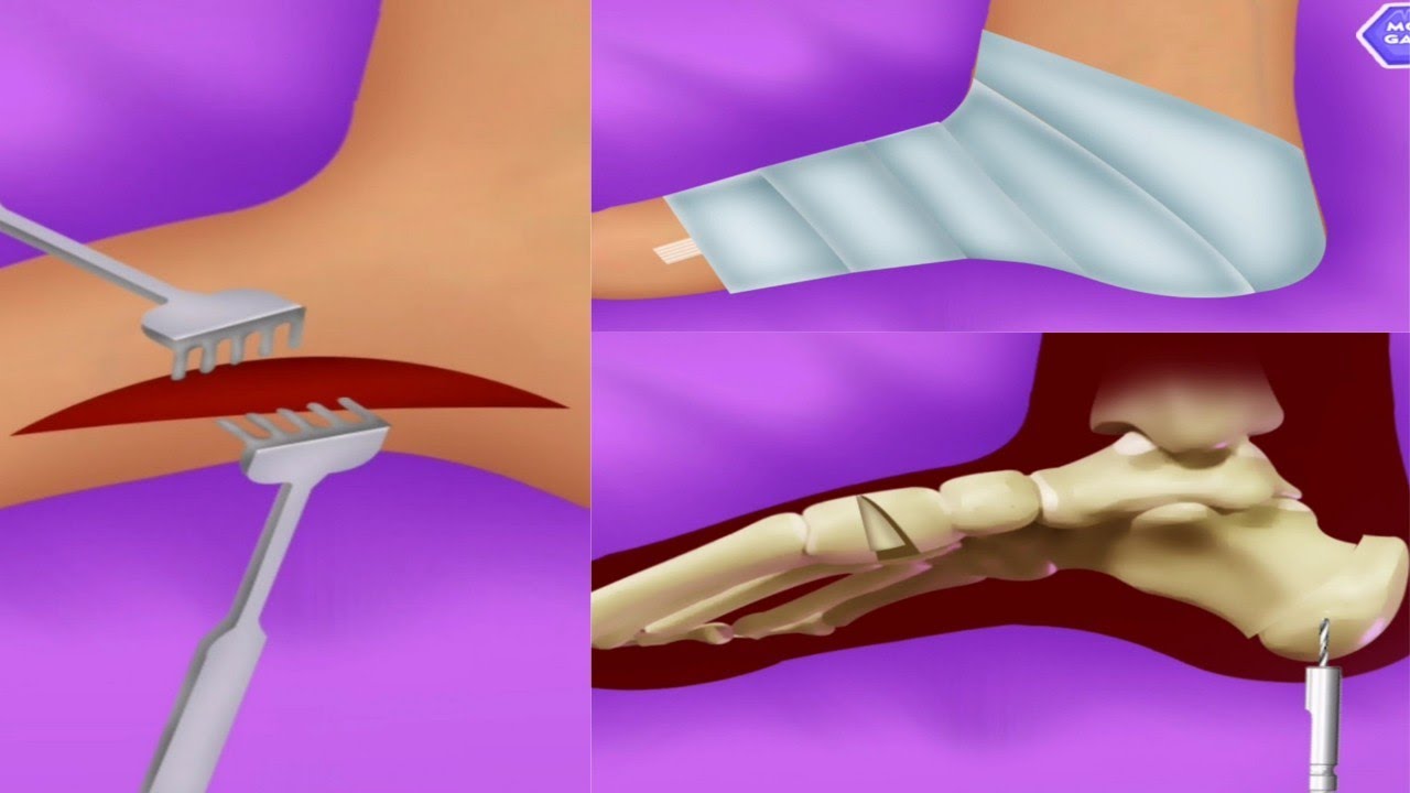 ASMR satisfying Removal, leg surgery process YouTube