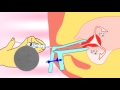 Intrauterine insemination (IUI) video.flv about infertility and ivf treatment