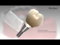Dentium prosthesis procedure