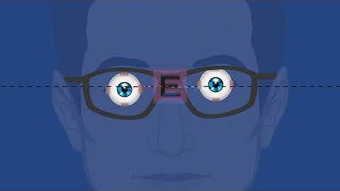 Vertical Heterophoria (Binocular Vision Dysfunction) Animation