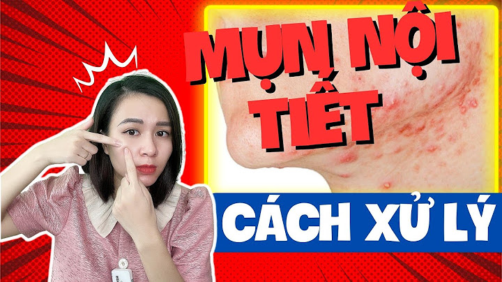 Mụn nổi dưới cằm là bệnh gì