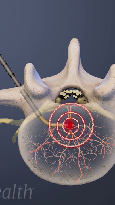 Minimally Invasive Fix for Spine Pain: Basivertebral Nerve Ablation Explained