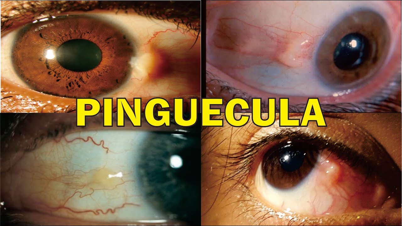 PINGUECULA, Definisi, Penyebab, Gejala, Pengobatan, Komplikasi & Pencegahan