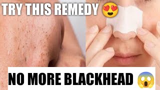 How to remove blackheads naturally by three easy steps/ Steam/Exfoliate/Toner