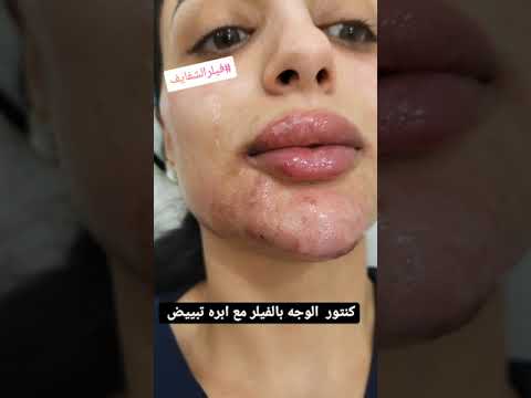 فيلر كنتور الوجه مع فيلر شفايف وتبييض تحت العين للهالات وابره دكتورة نسمه للنضاره