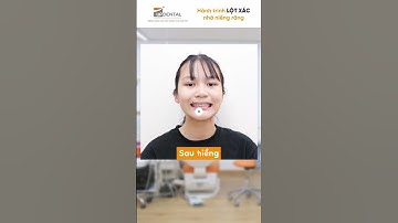 Hành trình LỘT XÁC nhờ niềng răng của Gia Bảo  #updental #braces