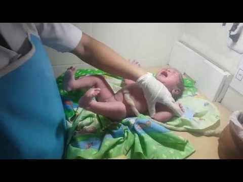 pemotongan tali pusar bayi baru lahir 20180307