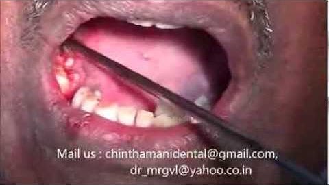Painless extraction of molar rootstumps and immediate implants video part 1