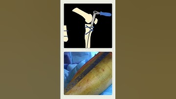 Suprapatellar Tibial Nailing – Key Steps and Locking Sequence