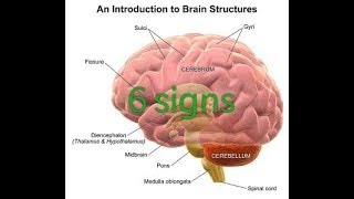 Edema treatment perilesional in brain