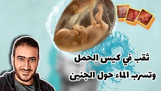 ثقب في كيس الحمل بسبب الإهمال أحياناً..خدي بالك وما تعمليش كده