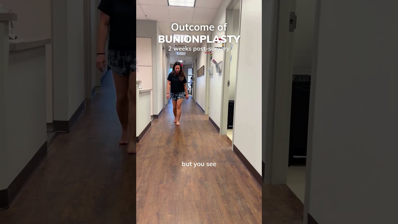 Walking Just 2 Weeks After Bunionplasty Surgery Dr Justin Kane OINT