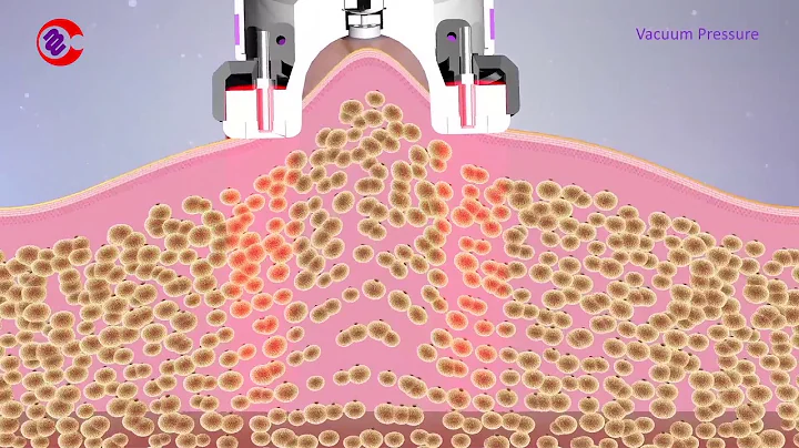 How Vacuum RF Fat Reduction Skin Tightening Treatment Work|Slimming Lymphatic Drainage Machine