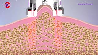 How Vacuum RF Fat Reduction Skin Tightening Treatment Work|Slimming Lymphatic Drainage Machine screenshot 5