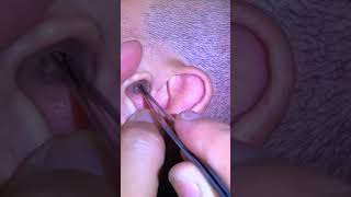 Ear Cleaning #313