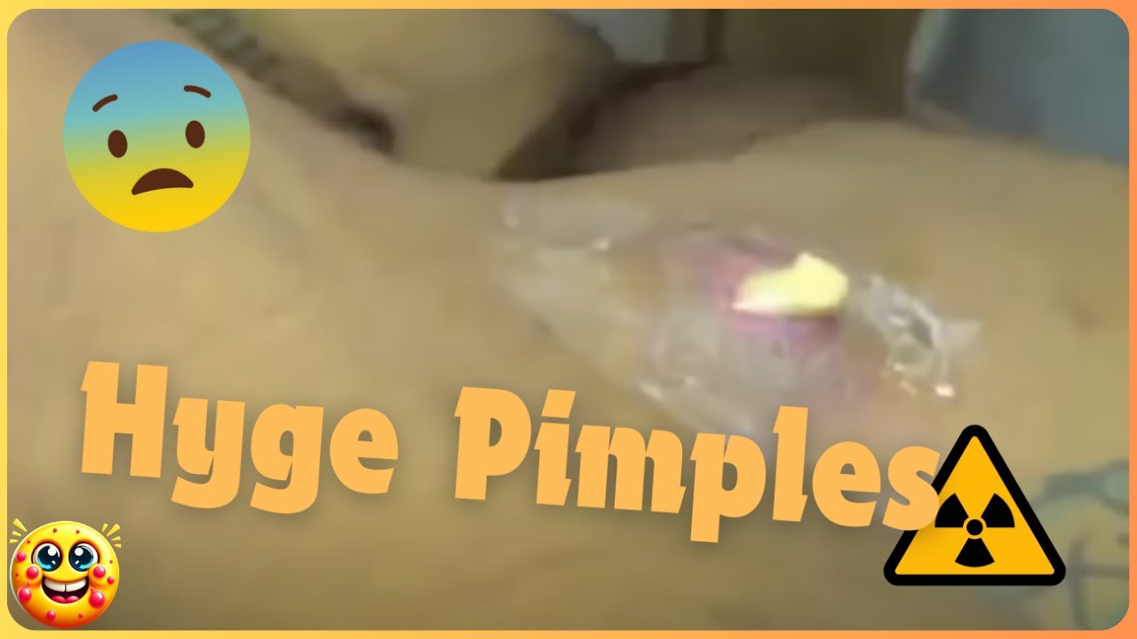 Huge Cysts And Pimple Poppingtry Not To Look Away Youtube