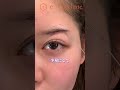 脂肪切除メイン眉下リフト👀#眉下リフト #眉下切開