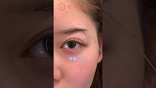 脂肪切除メイン眉下リフト👀#眉下リフト #眉下切開