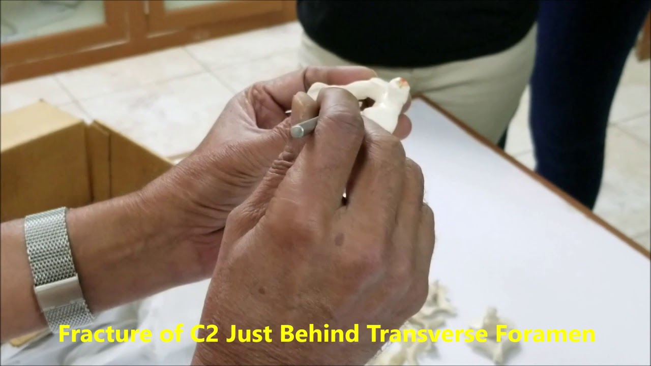 CERVICAL VERTEBRAE ATLAS AXIS Demonstration and Clinical Aspects - Sanjoy Sanyal