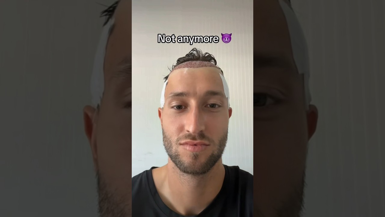 HAIR TRANSPLANT RESULTS - YouTube