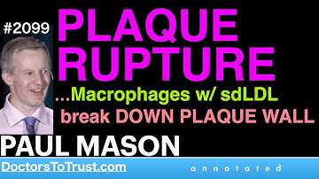 PAUL MASON c5 | PLAQUE RUPTURE …Macrophages w/ sdLDL  break DOWN PLAQUE WALL