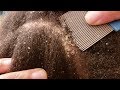 Dandruff Scratching Dry Flakes Popping