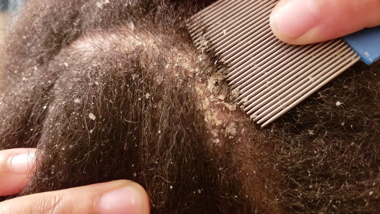 How to get rid of Minoxidil Flakes  HairMD Pune