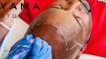 Can I Wear a Hat After Scalp Micropigmentation? An SMP Practitioner Explains