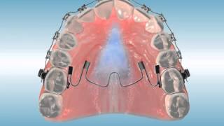 Nitanium® Molar Rotator²™ Multi-Purpose Finishing Appliance