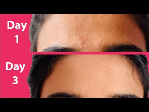 ACNE Treatment At Home | 3 day Acne REMOVAL Challenge | Acne Treatment Ayurvedic with Results