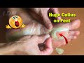 Callus Removal From Feet - 足からのカルス除去＃61