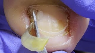 The complete trimming process for yellow ingrown toenails!