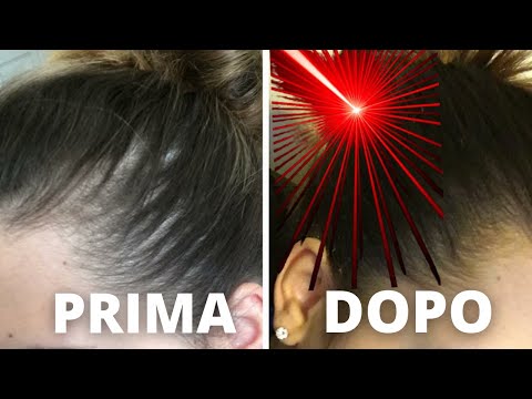 trattamento laser capelli I LASER TERAPIA PER LA CADUTA DEI CAPELLI