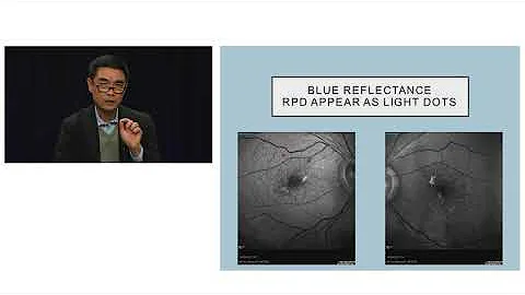 Case studies and Practical Tips on OCT Angiography...