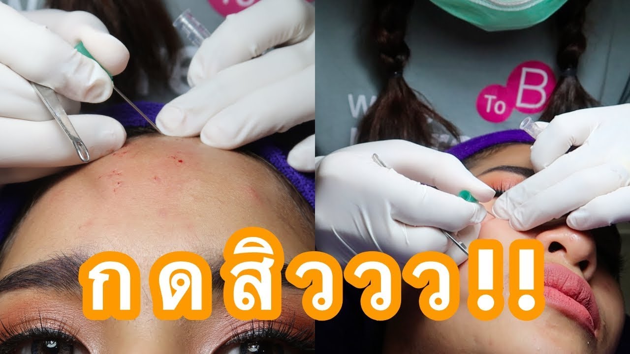 กดสิว เจ็บมั้ย มีรอยมั้ย หายจริงมั้ย กดที่ไหน เท่าไหร่คะพี่ | mossster