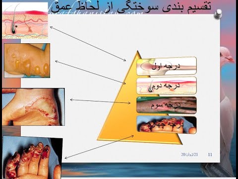 burning & first aid سوختگی ها واقدامات اولیه