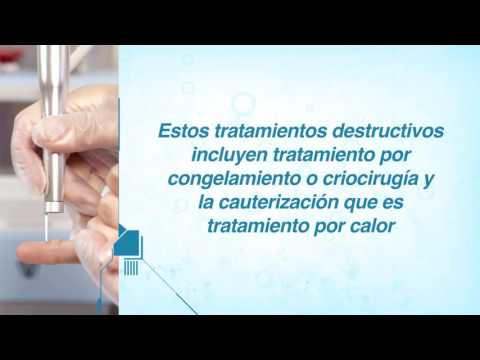 Vídeo: Eliminación De Verrugas Genitales: Posibles Métodos Y Sus Beneficios