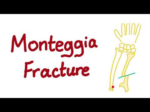 Vidéo: Instabilité De L'articulation Radio-ulnaire Proximale Dans Les Fractures De Monteggia - Une étude Expérimentale
