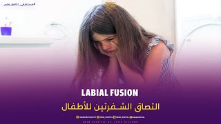 التصاق الشفرتين للأطفال🙎‍♀️ حالة من النادر انك تشوفها - متخليش الفيديو يفوتك