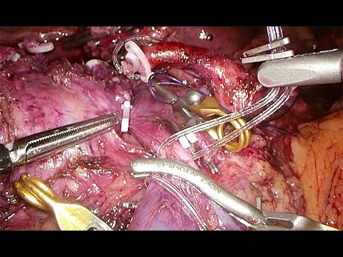 Video: Pancreas Poliep