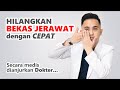Rahasia Sukses Menghilangkan Bekas Jerawat Pih