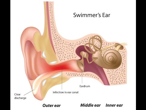 Video: Otitis Externa (otitis Externa) U Dospělého - Příčiny, Příznaky A Léčba Otitis Externa