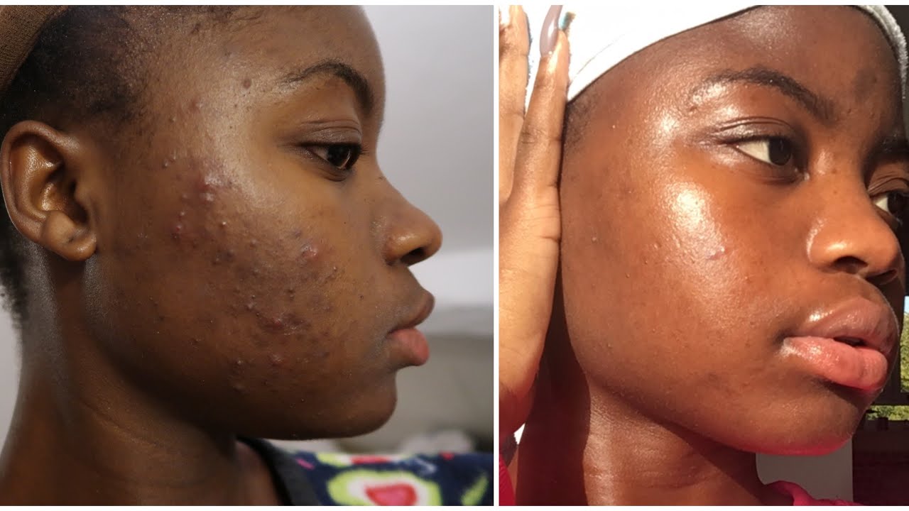 Bilan 2 Mois Traitement Curacnéroaccutane Accutane Treatment Peau