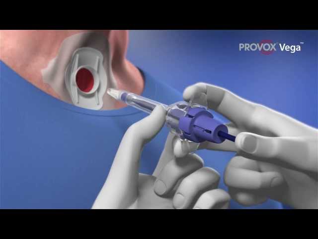 Helping Restore Speech After Laryngectomy: Complete Guide to Provox Vega Voice Prosthesis Insertion. class=