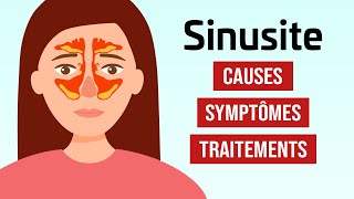 Sinusite : causes, symptômes et traitements  Index Santé