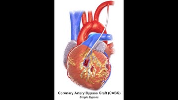 Coronary Artery Bypass Graft (CABG) - Arterial & Venous, Composite - Dr Rams Medical Coding Academy