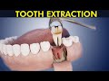 The Tooth Extraction Process: Step by Step