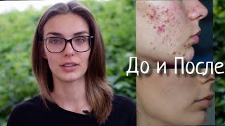 5 самых частых вопросов! Когда  все закончится? Обострение! Выпадение волос!  ЛЕЧЕНИЕ АКНЕкутан