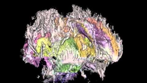Fractional Anisotropy with Region of Interest Diffusion Tensor MRI - William Edward Hahn