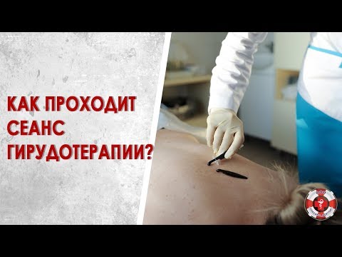 На сеансе гирудотерапии. Когда эффективно лечение пиявками?